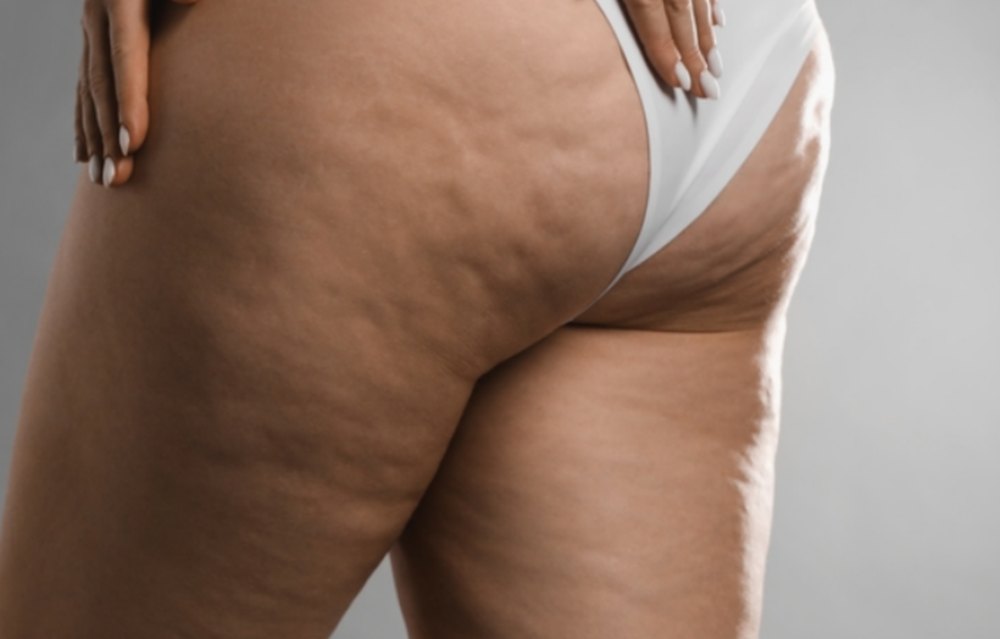 Detalhe da coxa de uma mulher, representando o lipedema